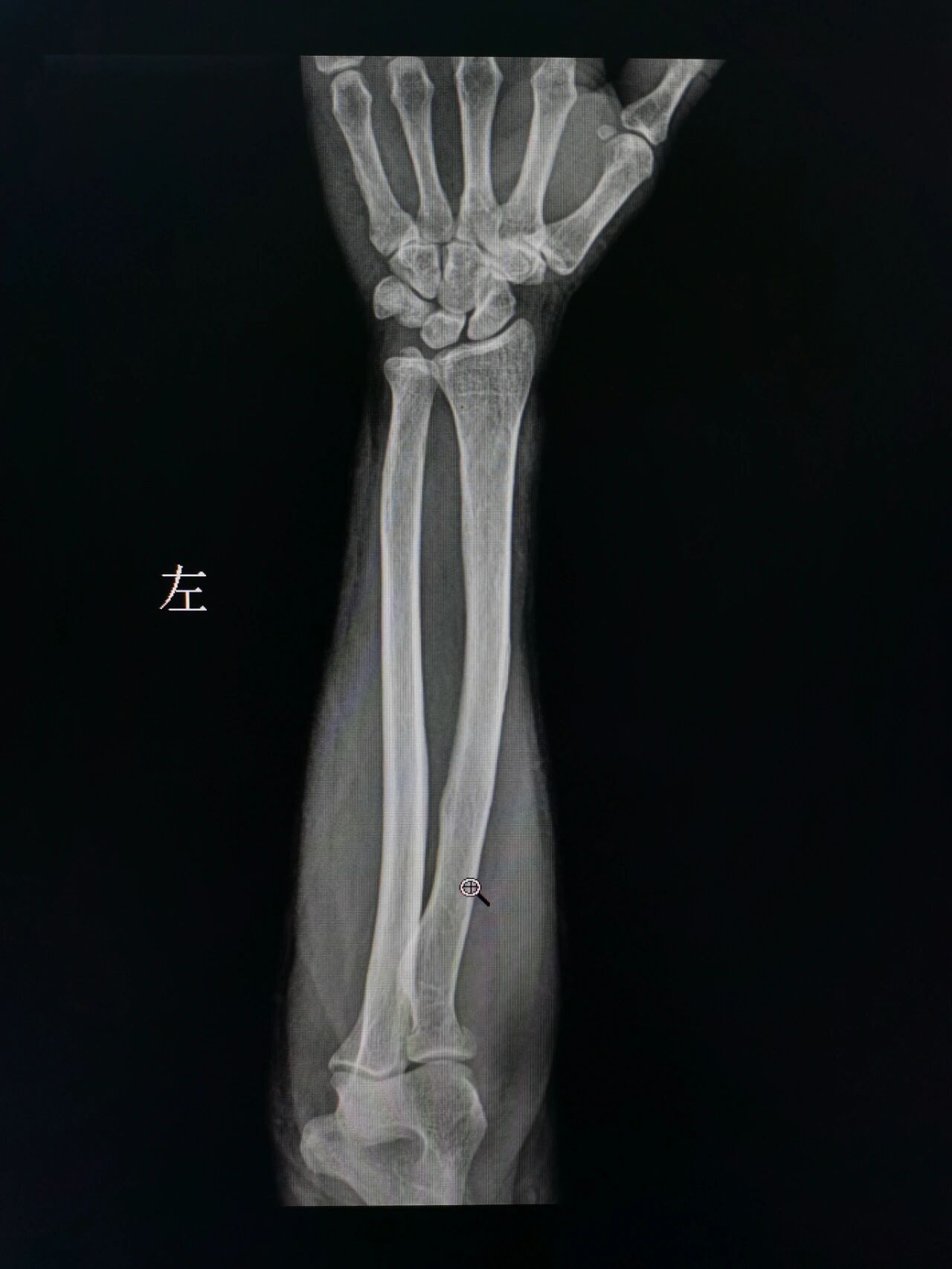 dr尺桡骨正侧位体位哪不对啊!