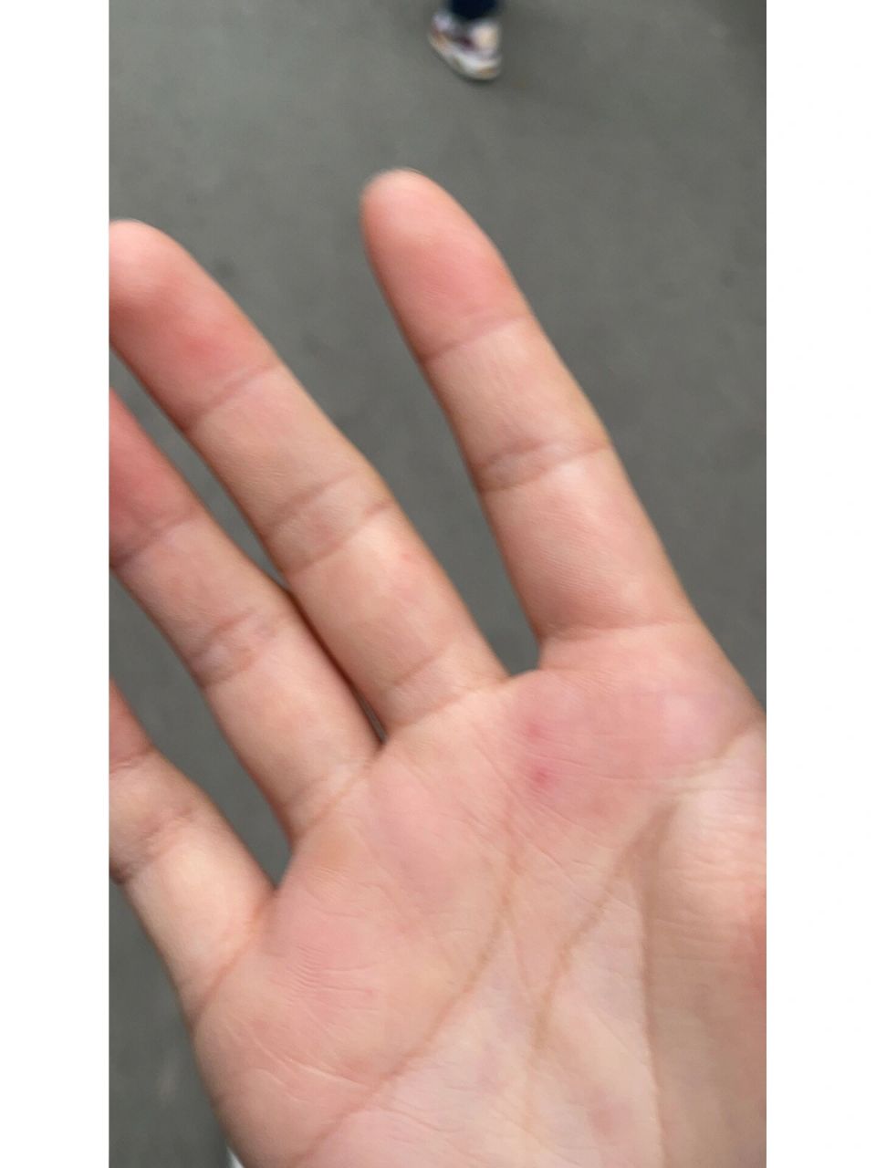 上突然出现的这两个小红点是什么呀 求告知啊 刚刚开始的时候不痛不痒