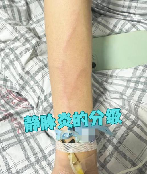 静脉炎的分级主要看症状轻重,一般分为0到4级