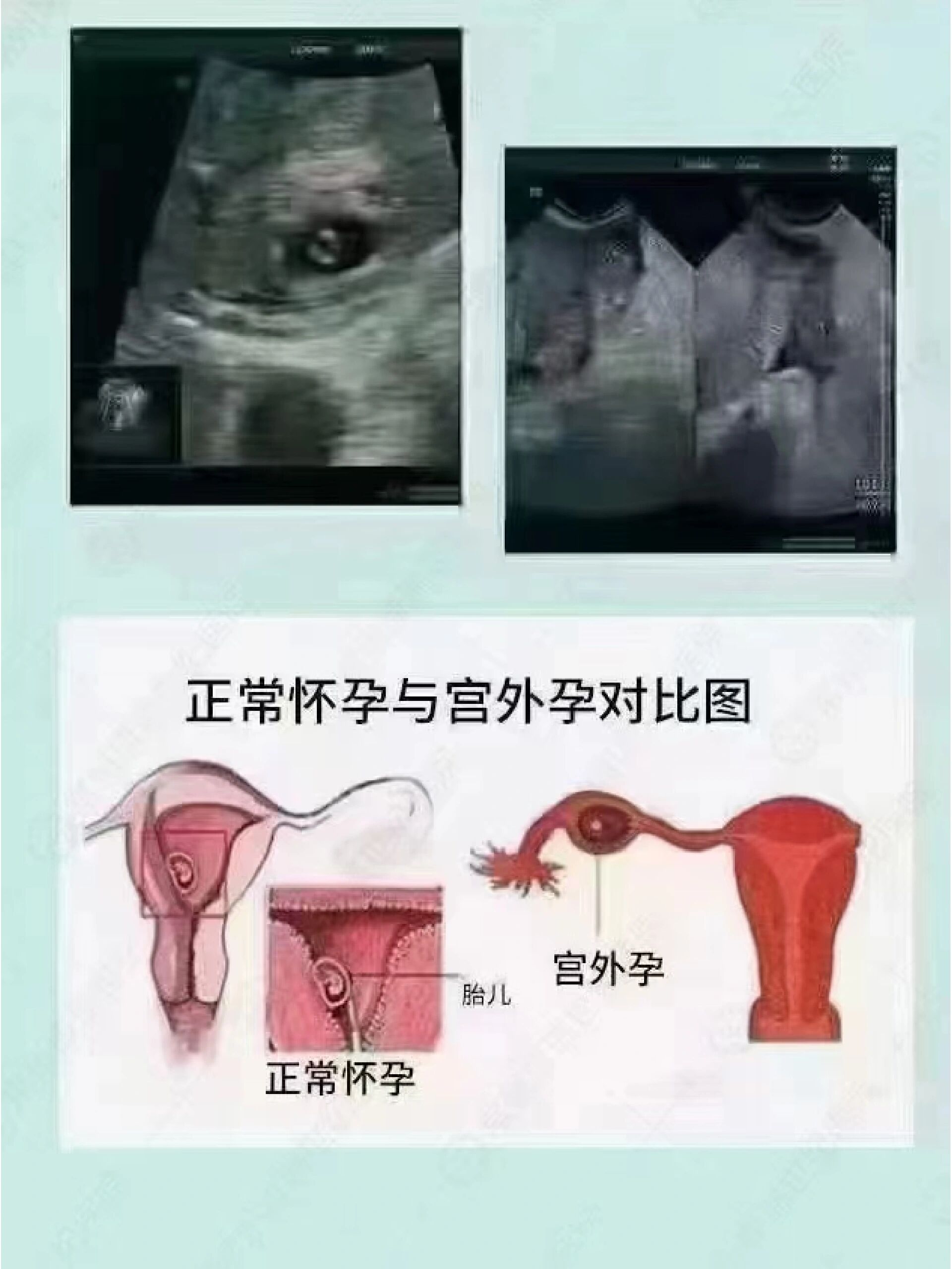 正常妊娠图片图片