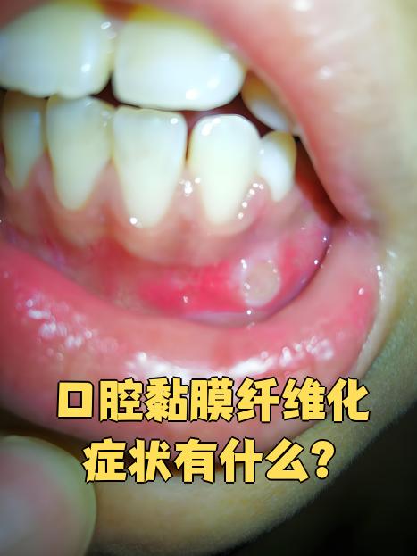 口腔黏膜纤维化最常见的症状包括烧灼感,起疱,破溃,味觉减退和张口