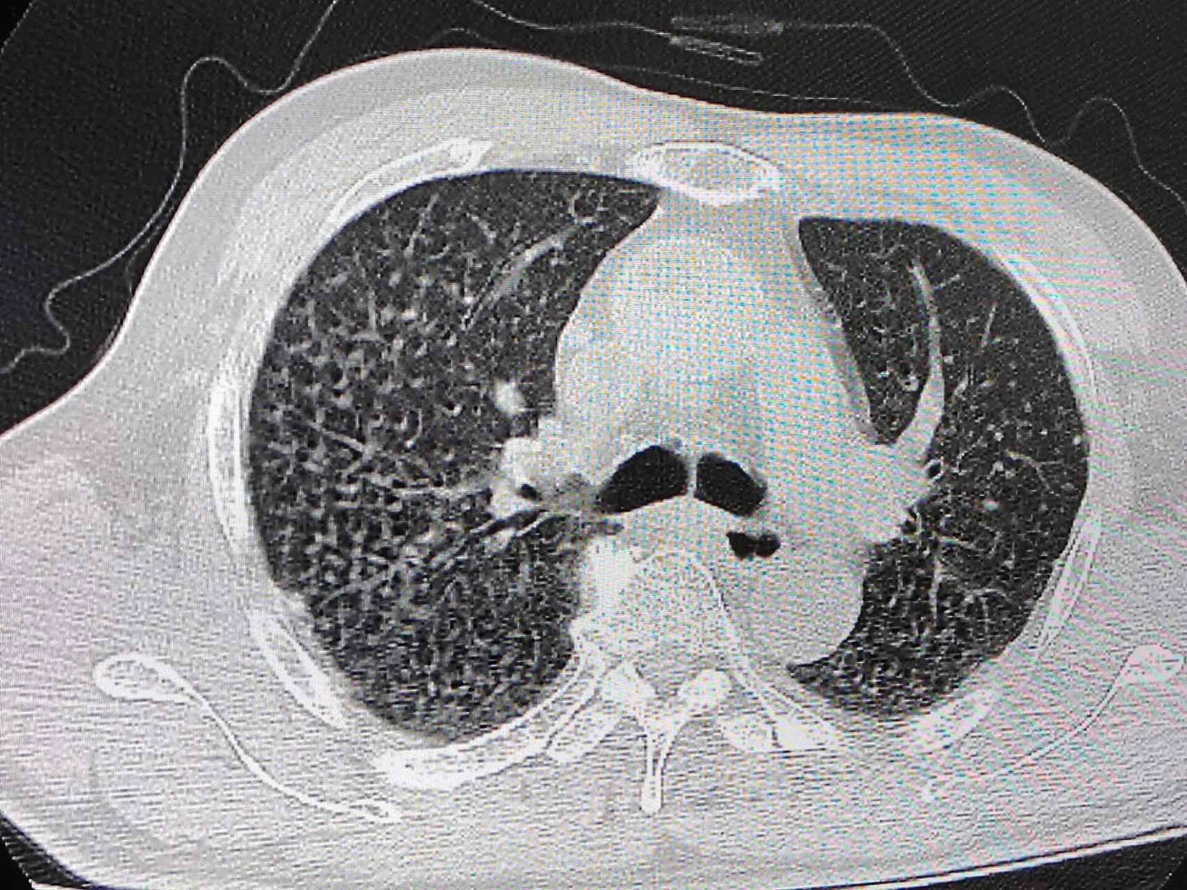 矽肺ct表现 两肺见弥漫多发粟粒结节影,可以看到两肺门,纵隔淋巴结轻