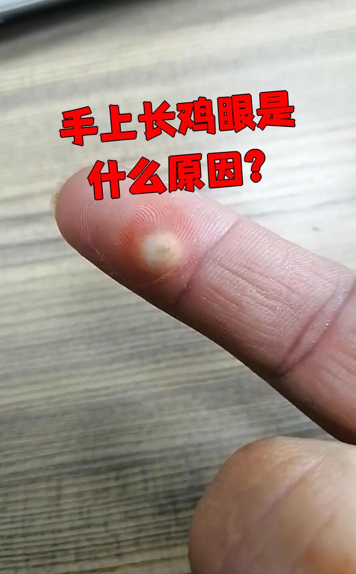手上长鸡眼最常见的原因是皮肤长期受到压迫和摩擦