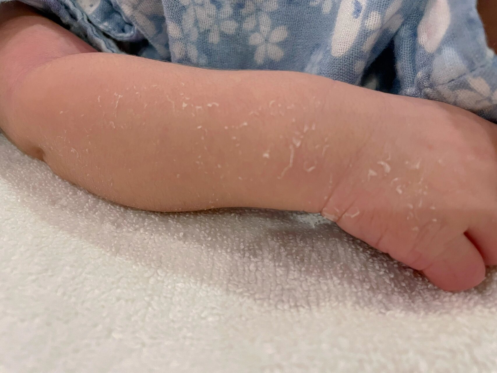 注意事项 宝宝皮肤最外面的一层叫角化层,内面的一层叫真皮,由于发育