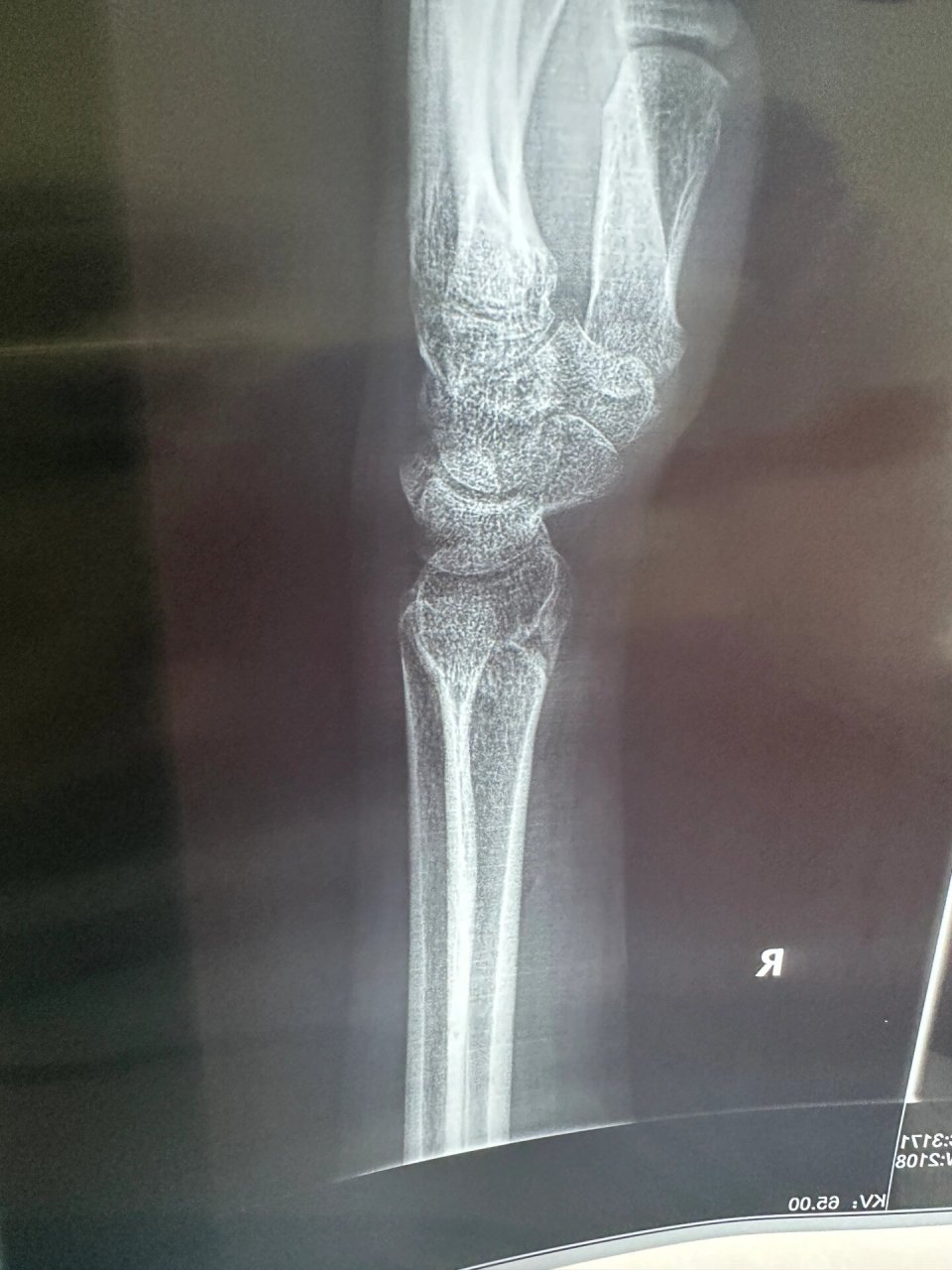 右手桡骨远端骨折,右手尺骨茎突 感觉弯曲的角度大了一点,不知道是不