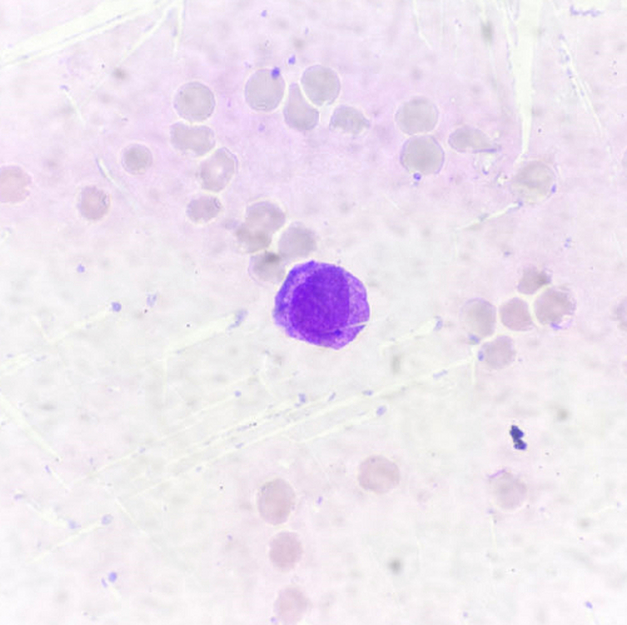 异常早幼粒细胞,隐约可见数条奥氏小体(图1),然而,当计数100个细胞并