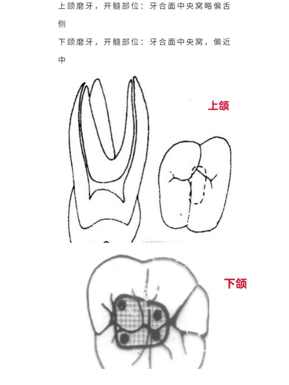 口腔开髓位置图图片