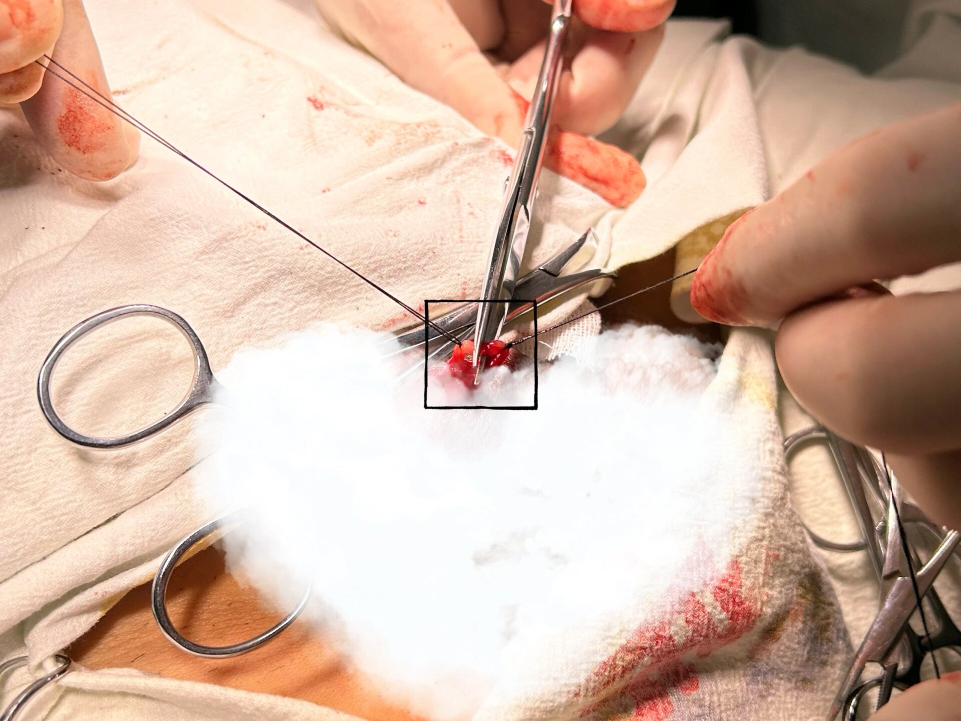 一例男性输精管结扎