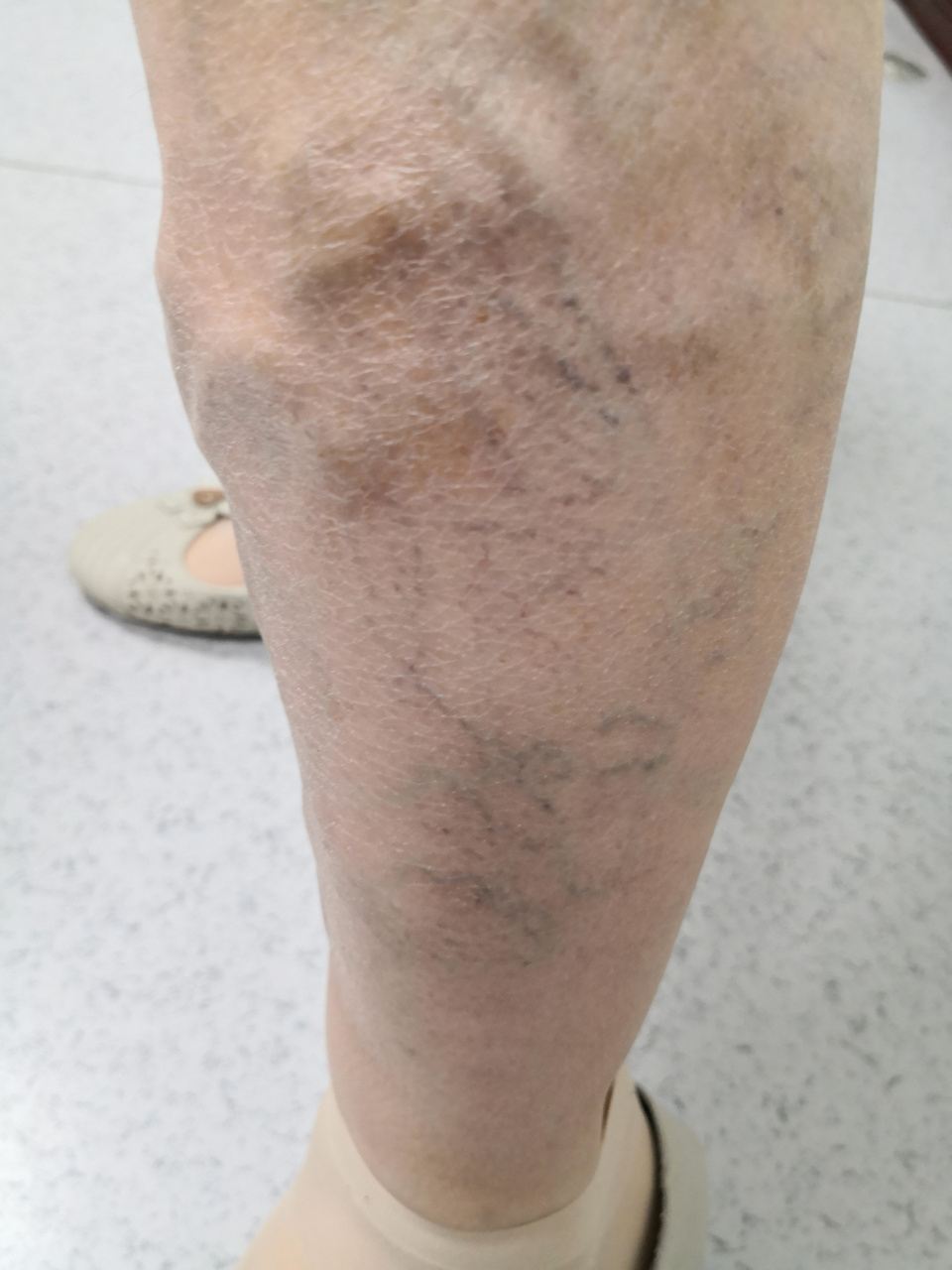 下肢淤积性皮炎图片图片