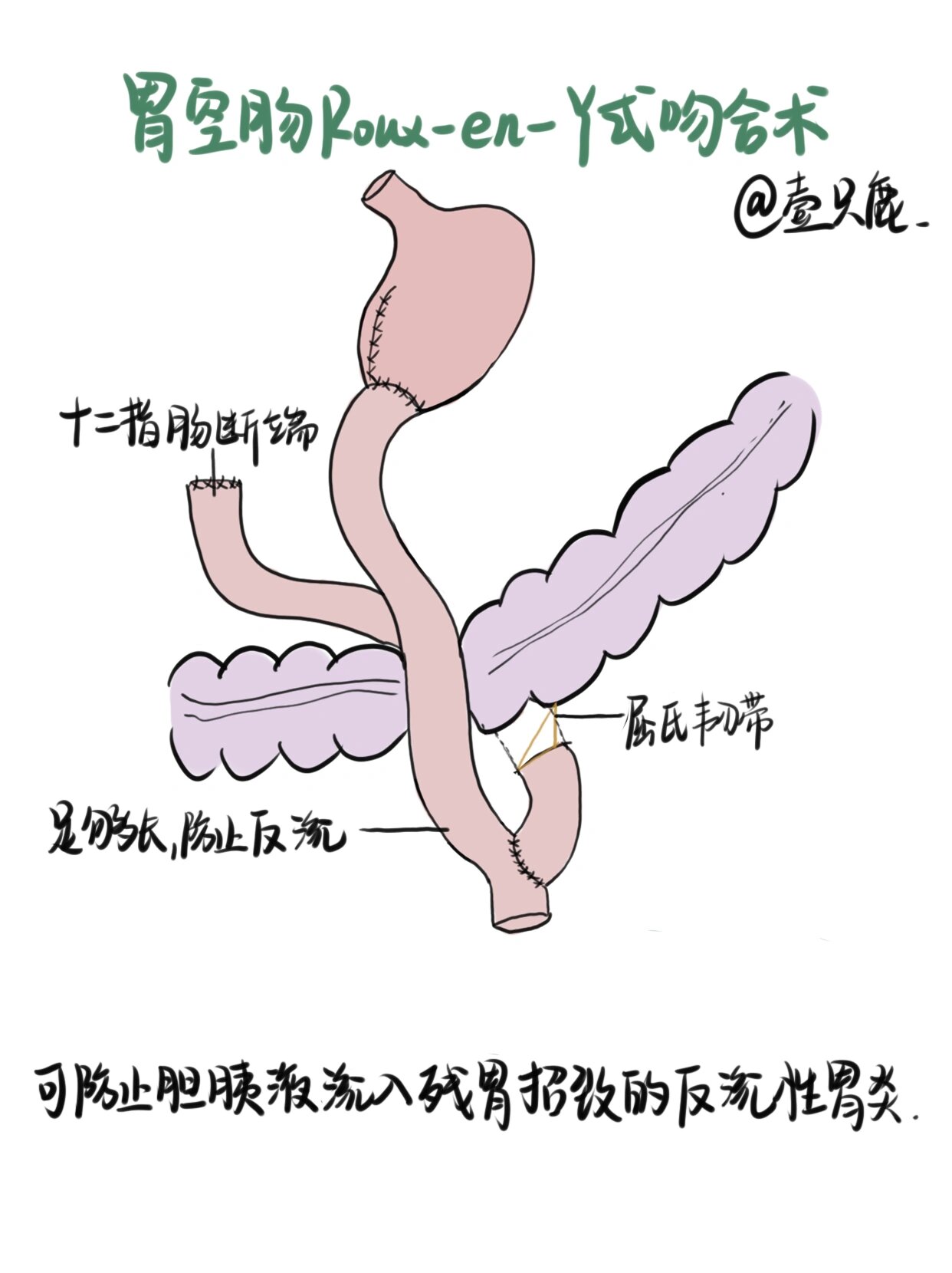 胃大部分切除手术图片