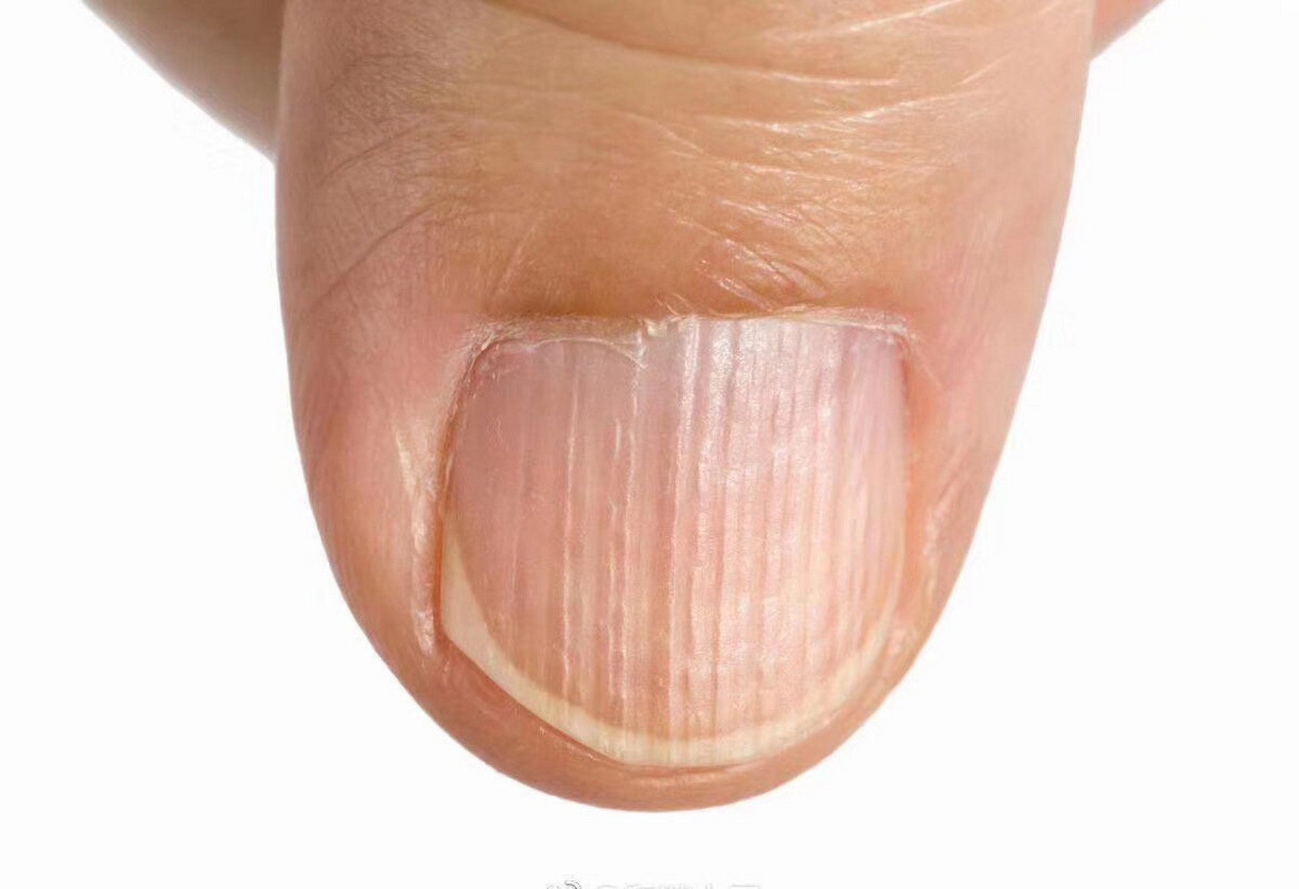 指甲上有纵行凹凸不平的条纹怎么办?