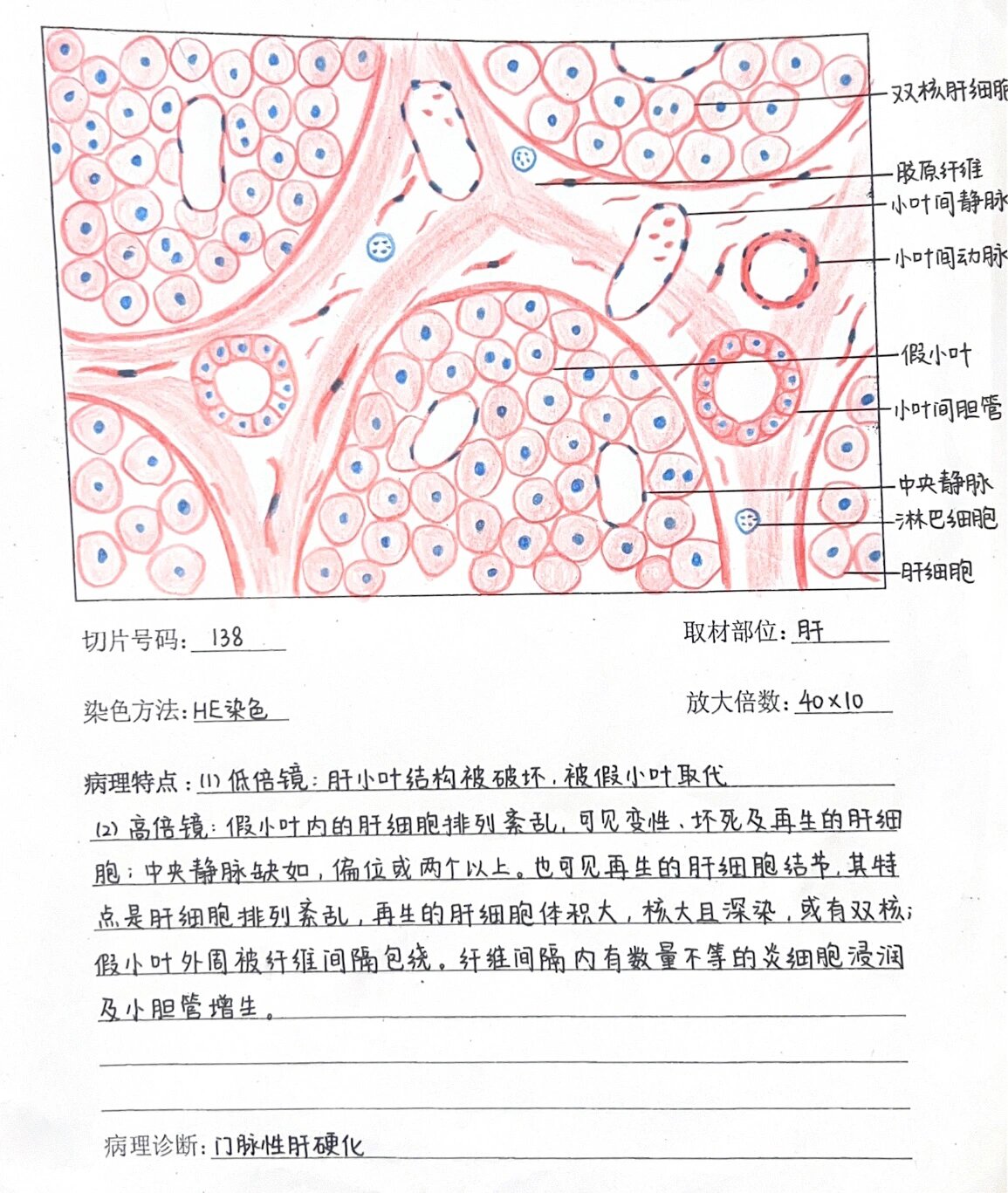 门脉性肝硬化10×10图片