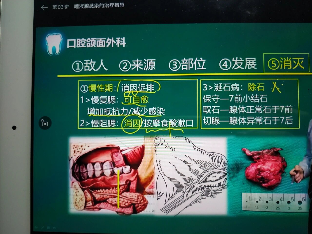 唾液腺感染性疾病的表现及辅助检查 1--急性化脓性腮腺炎(导管 腺泡)