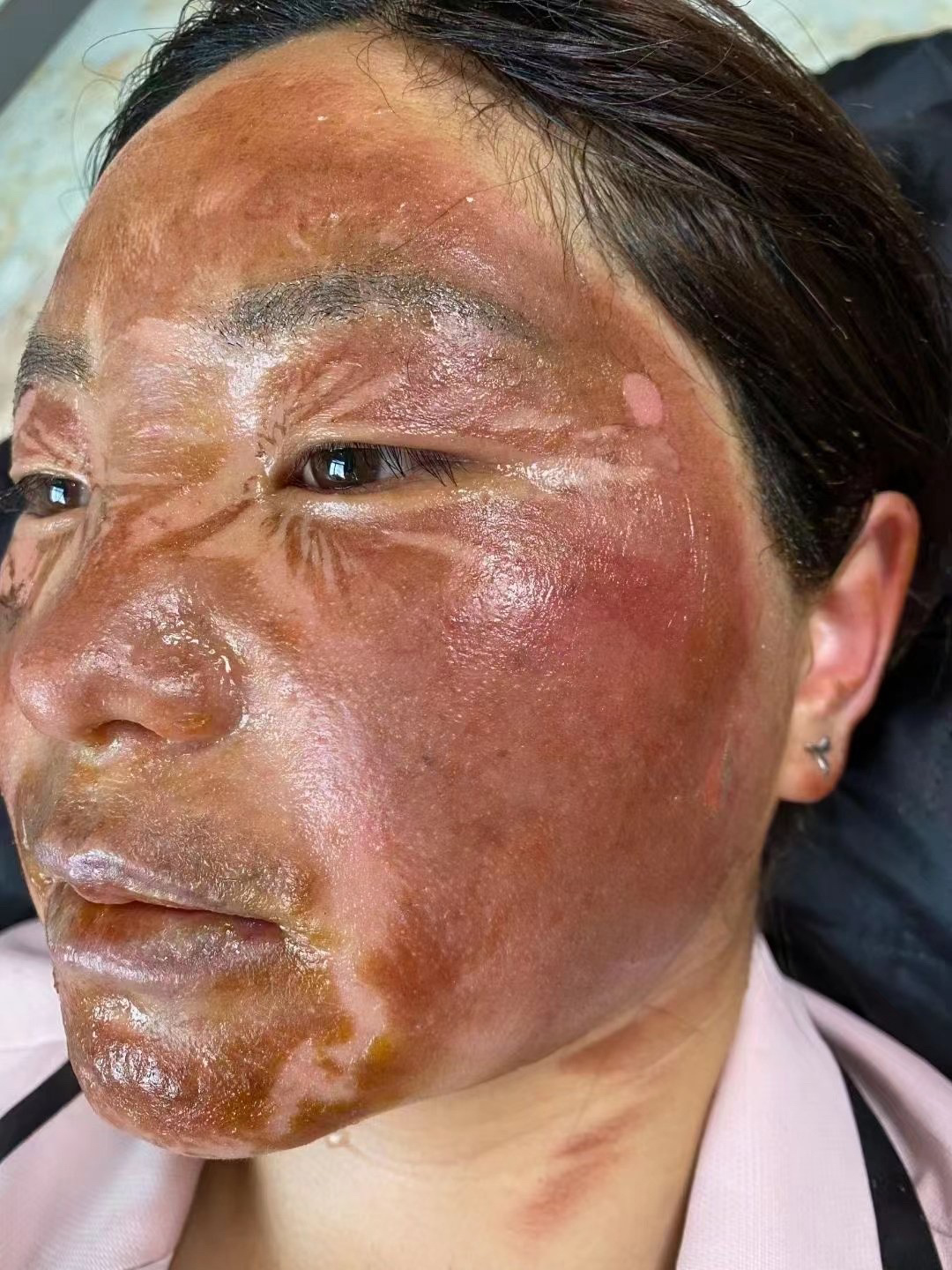 烧烫伤不留痕完美恢复又挽救了一个人一个家 烧烫伤不留疤不植皮不