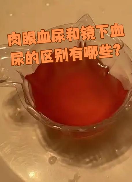 肉眼血尿和镜下血尿最明显的区别就是出血量不同