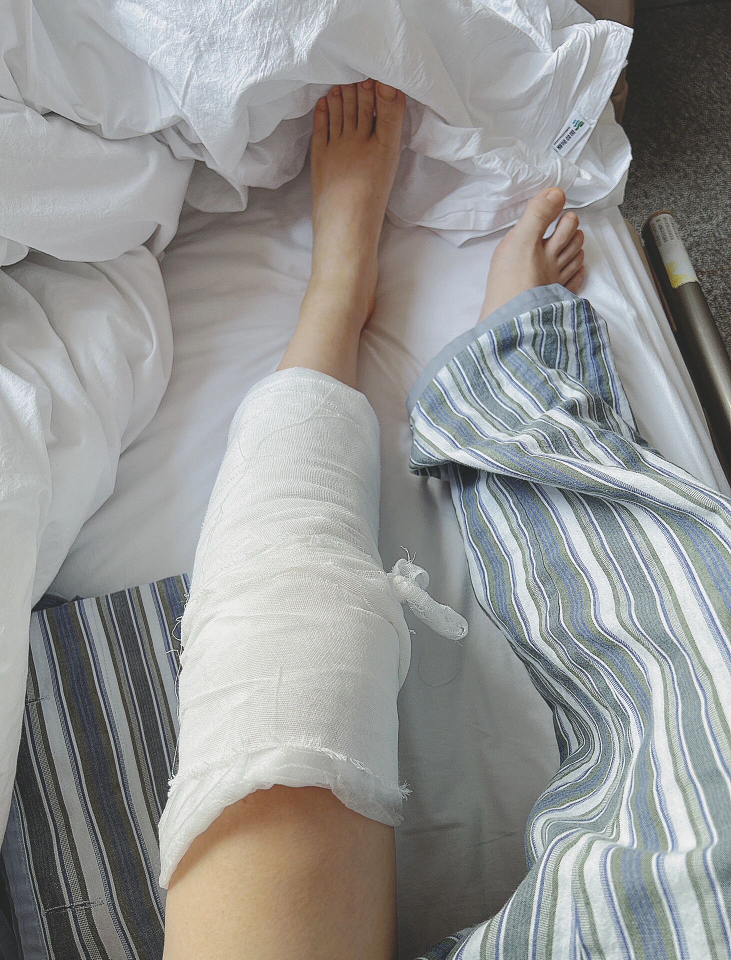 半月板撕裂,最后选择手术了 多灾多难的左腿,去年崴脚,今年半月板三级