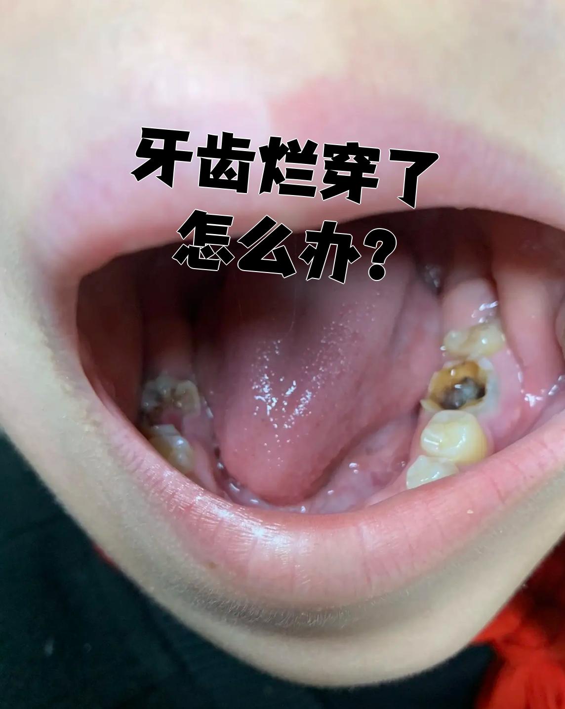 牙齿烂穿了怎么办?我来告诉你该怎么处理