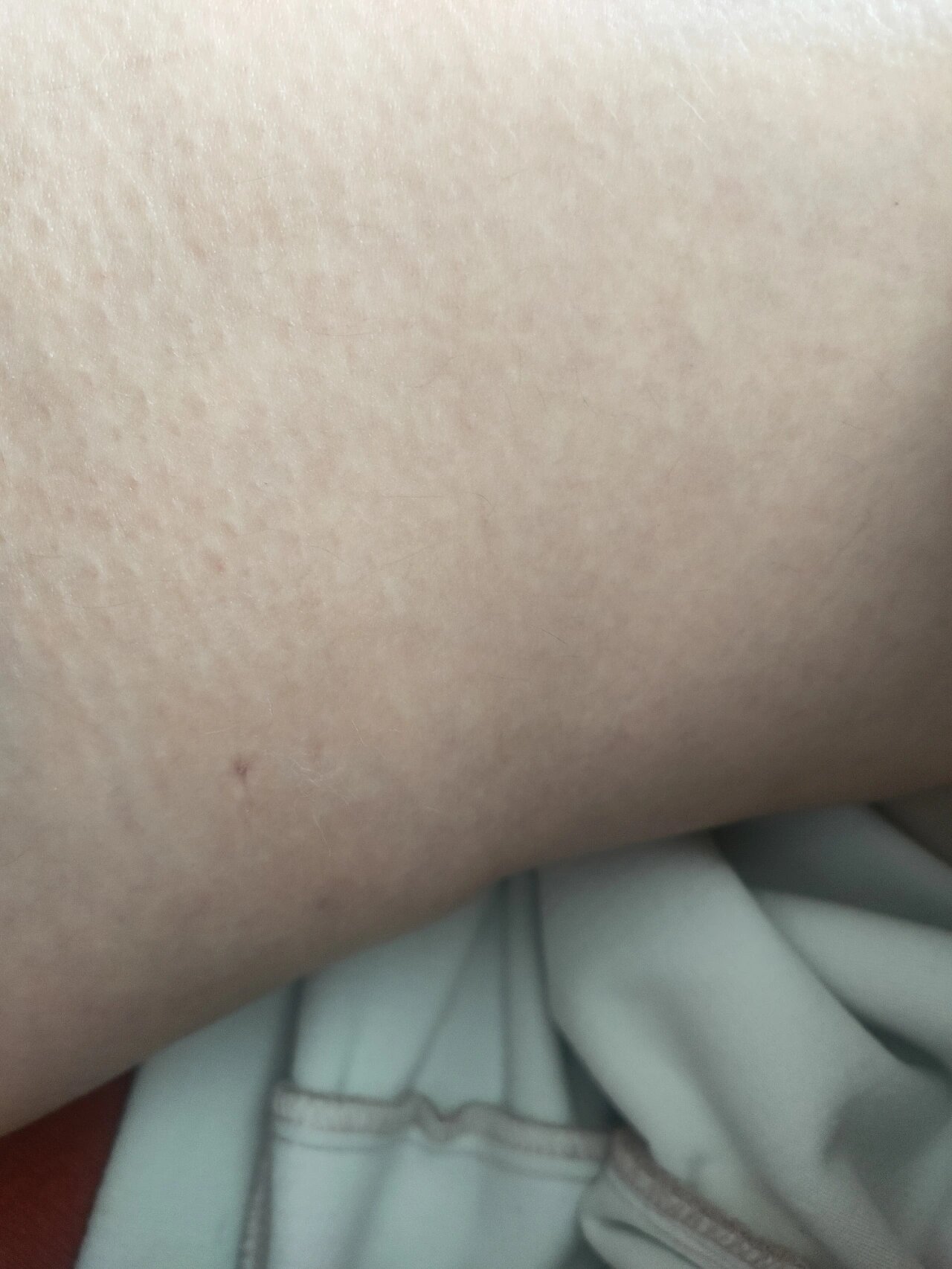 肝素!第一次打大腿内侧!