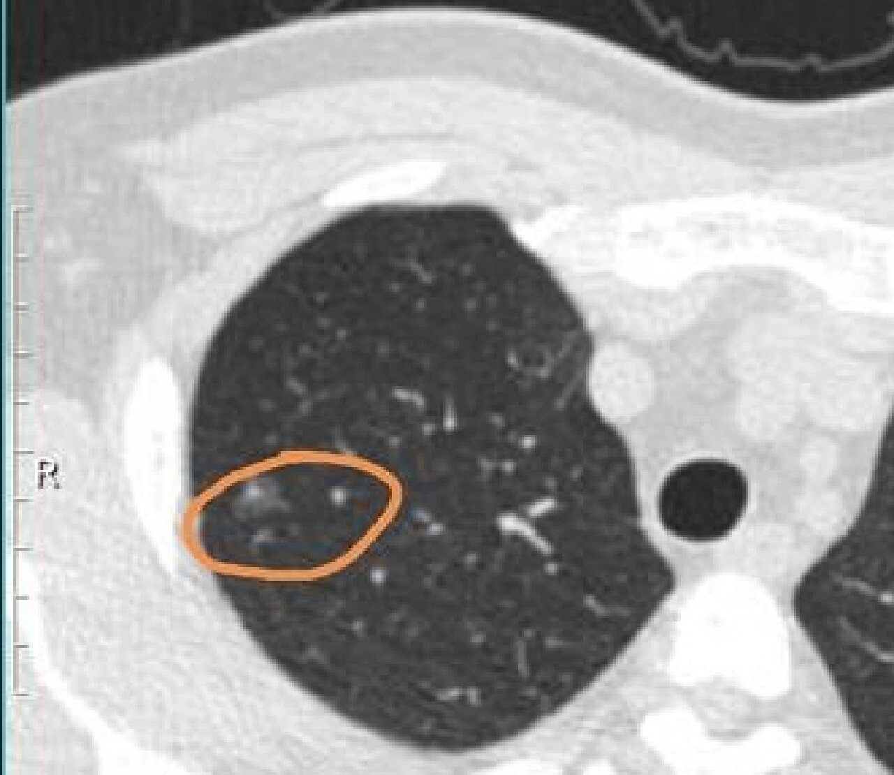混合磨玻璃结节代表性质超出原位癌了吗?