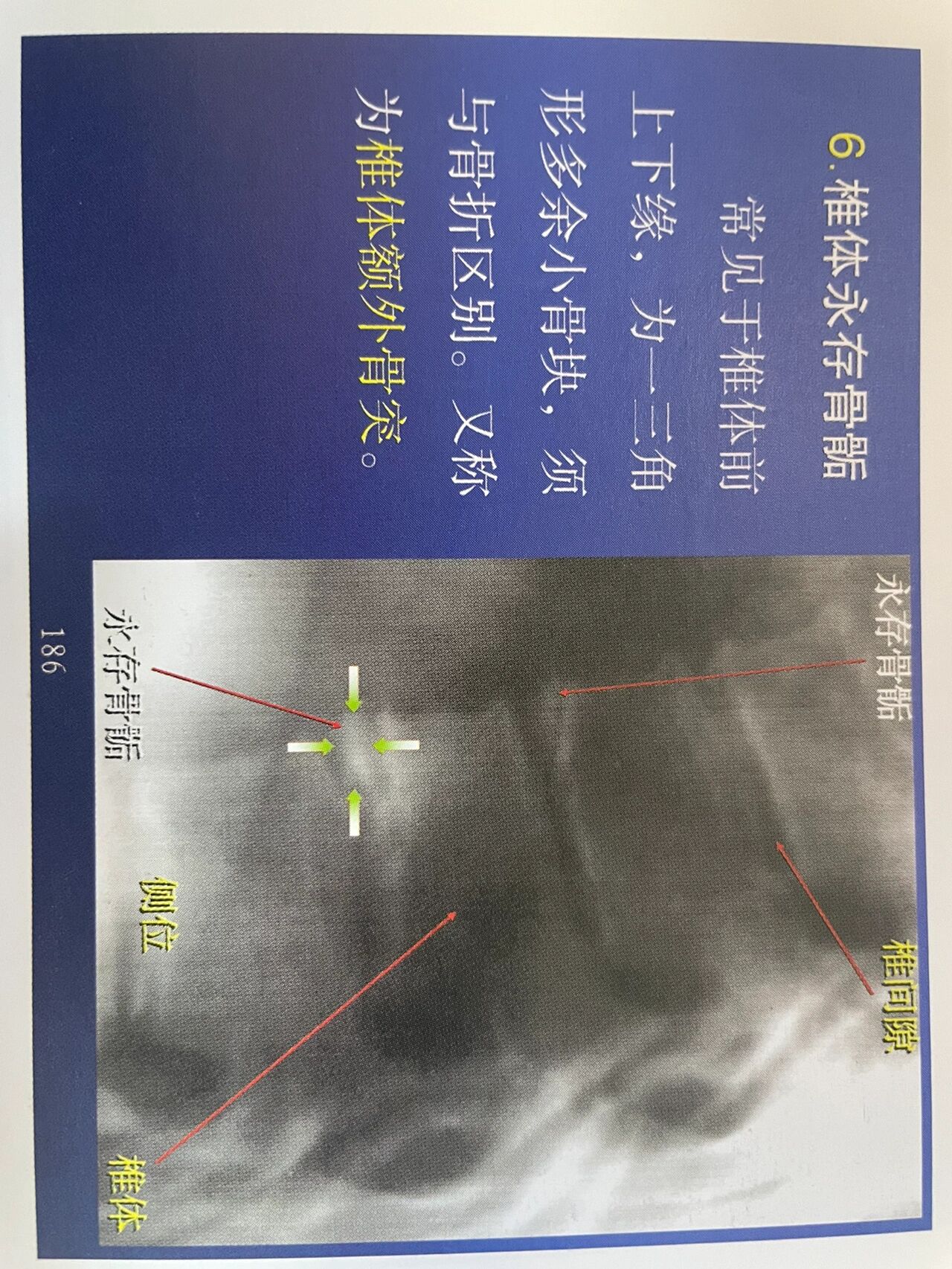 椎体楔形变图片