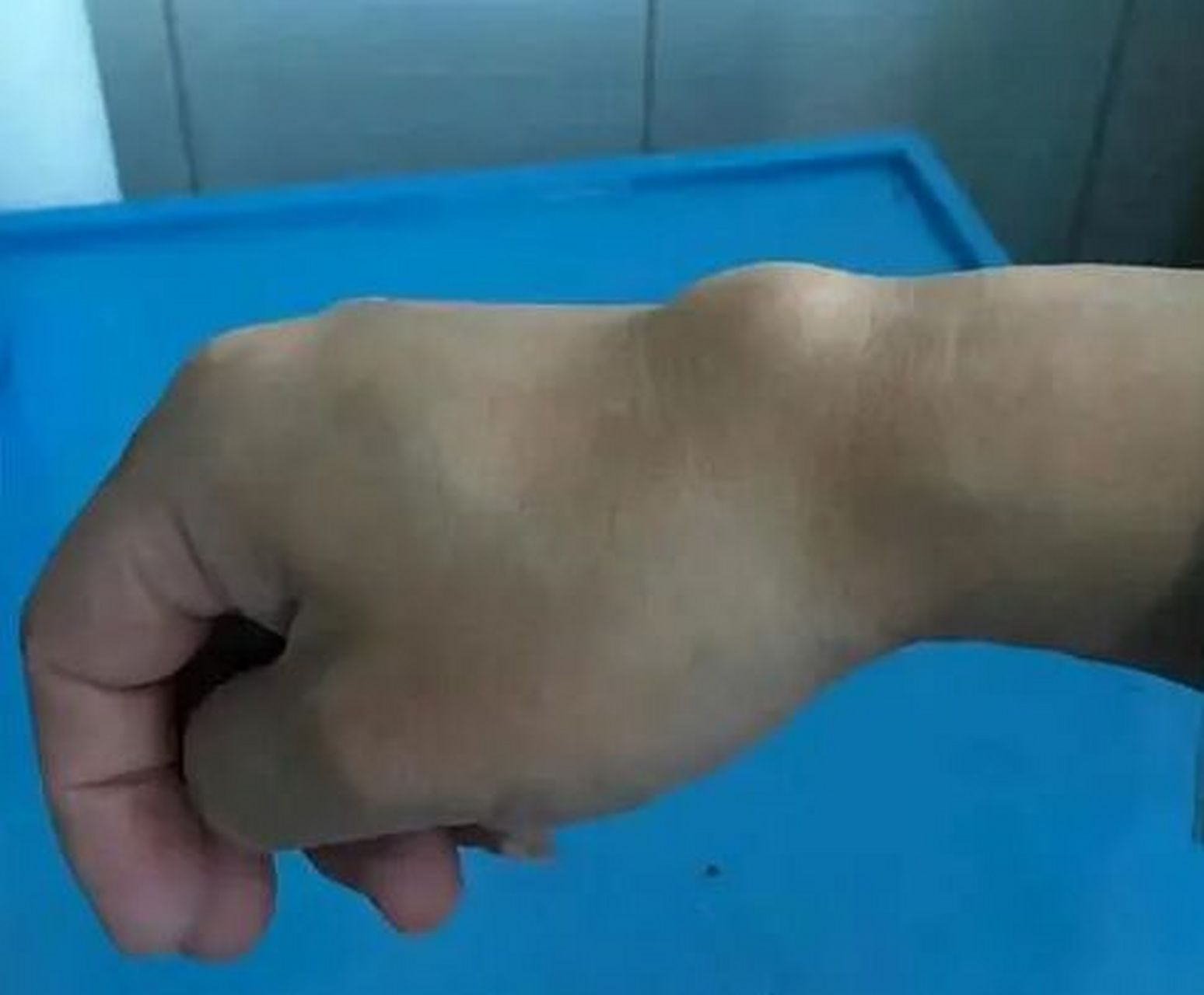 手腕腱鞘囊肿的治疗方法 是一种软组织损伤性疾病,其本质是人体关节