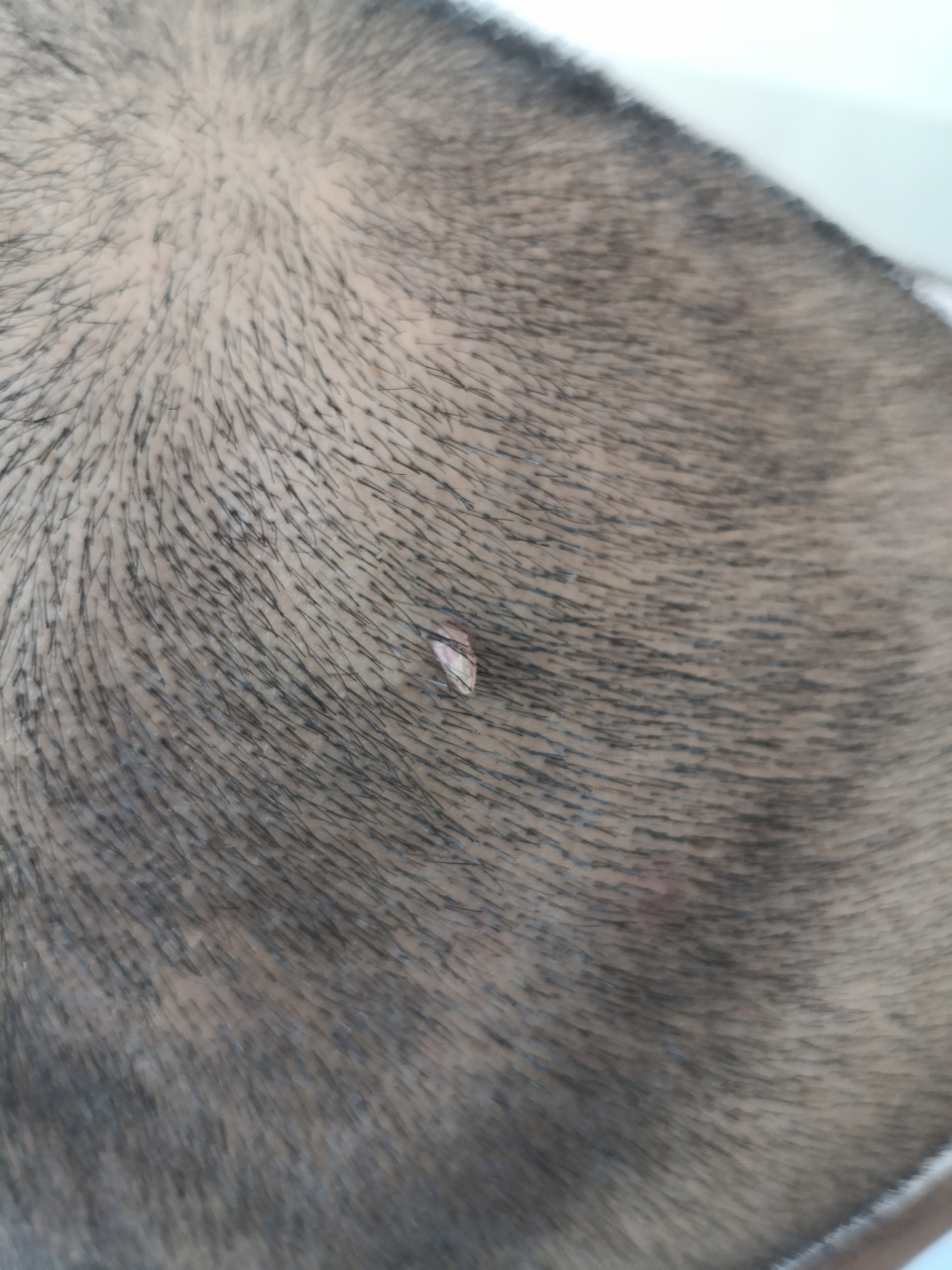 头皮疣状物激光治疗去除前后即刻对比图#美容##疣