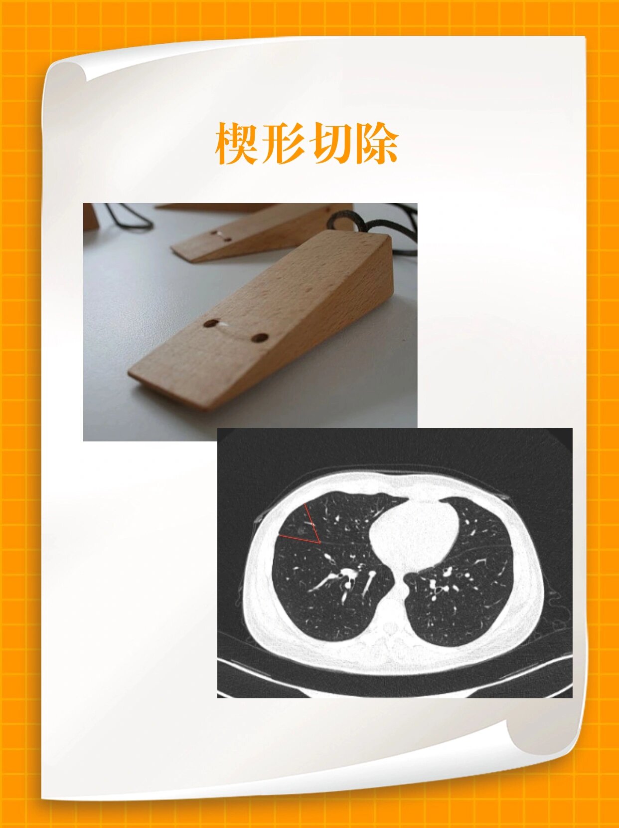 楔形切除,肺段切除,肺叶切除都是啥意思?
