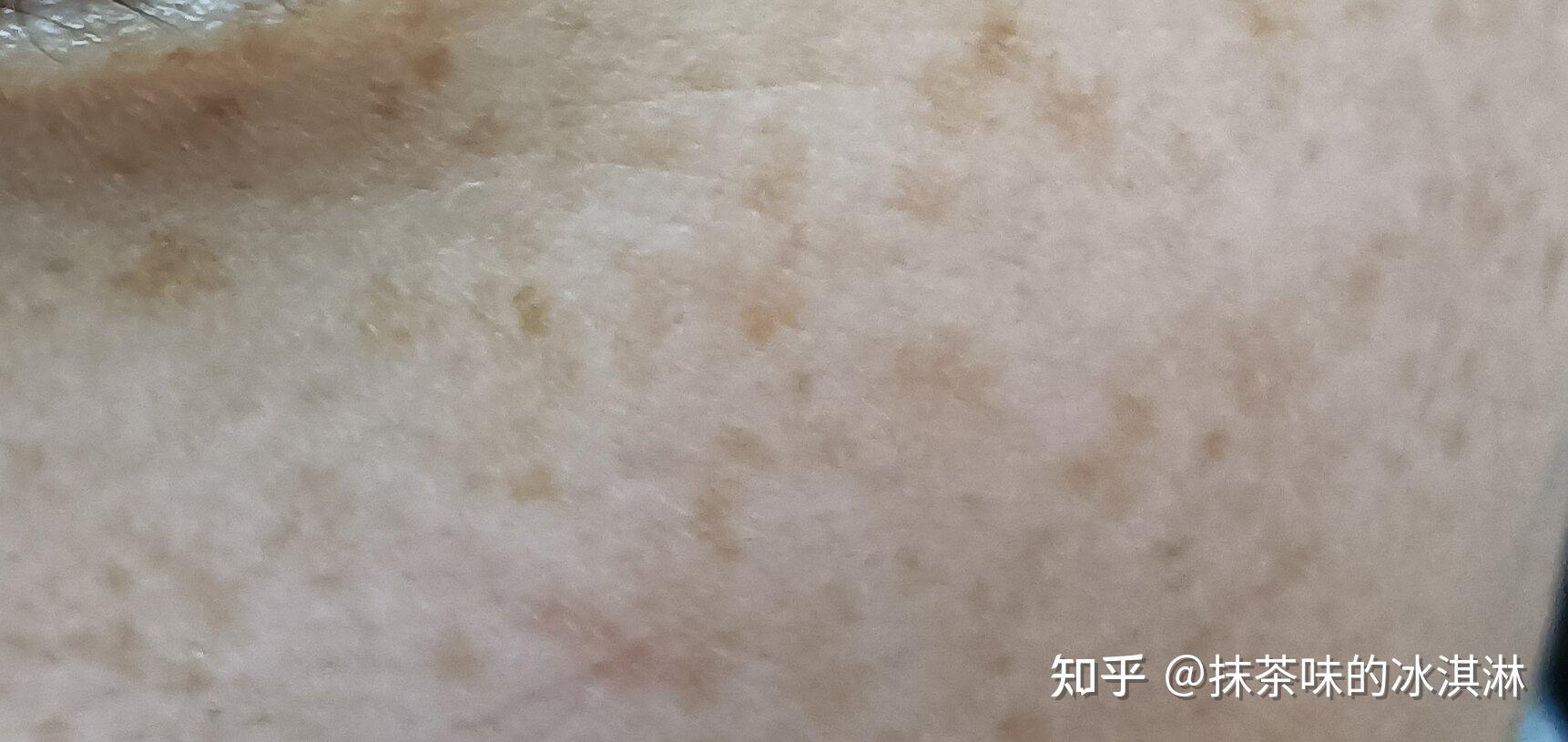 想去贵阳丽肤皮肤病医院做激光祛斑有人去过吗效果怎么样