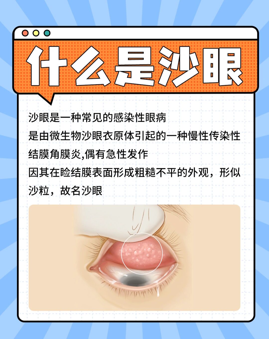 沙眼症状有哪些?应该怎么治