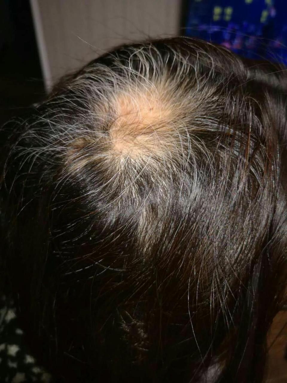 女性斑秃不可怕,好好治疗能恢复.  记得43岁时,身体开始进入紊乱期.