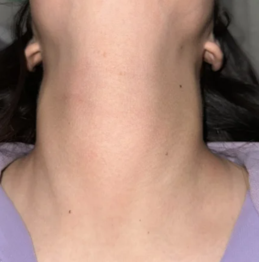 甲状腺癌早期通常没有明显症状,很多患者是在体检时发现颈部有肿块