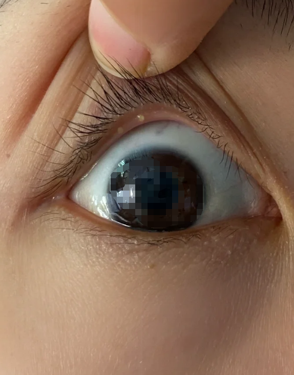 眼睛长东西可能是麦粒肿,霰粒肿或眼睛纤维瘤引起的