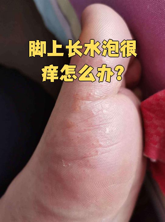 夏天脚上长水泡发痒,常见原因有四种:生理原因,汗疱疹,环境因素和湿疹