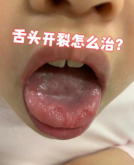 舌头开裂需要根据具体原因选择治疗方法,主要包括一