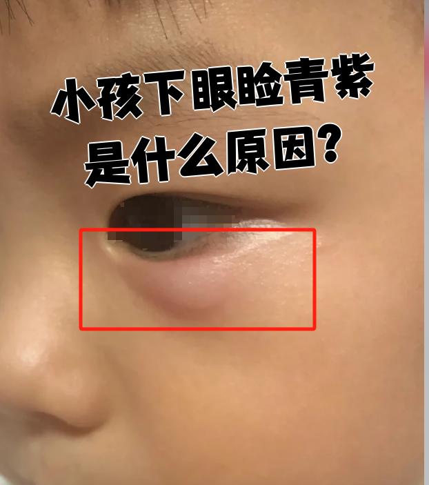 第一,睡不好会让孩子脸上血管淤血,下眼睑就容易发青
