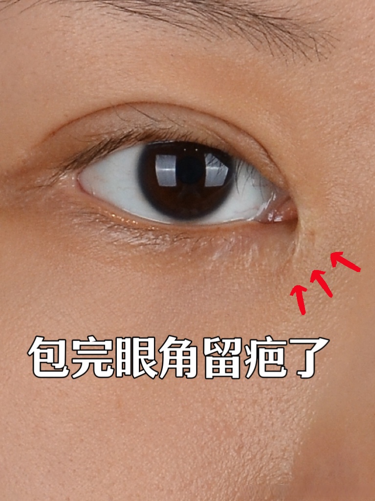 内眼角包眼角失败,疤痕严重!