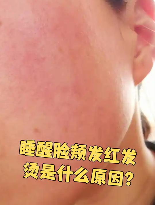 睡醒后脸颊发红发烫可能和更年期,皮肤过敏,炎症
