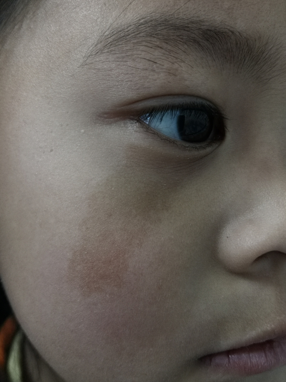 儿童一侧面颊部位的黄褐色斑片.考虑咖啡斑.可以手术切除治疗.