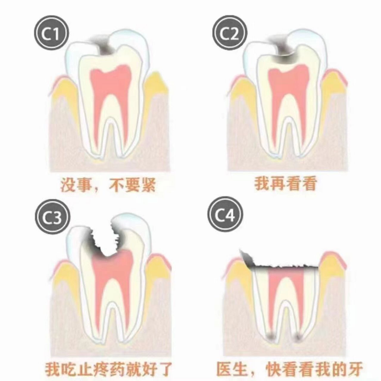 当你的牙齿发生蛀牙的时候 浅龋:不痛呀,没事,不要紧 中龋:看牙好贵