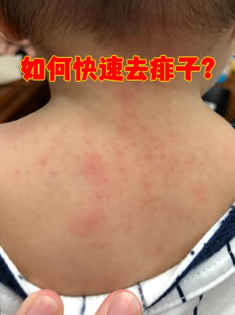 薄荷炉甘石洗剂和痱子粉效果不错,能清凉止痒.如果痒得厉害