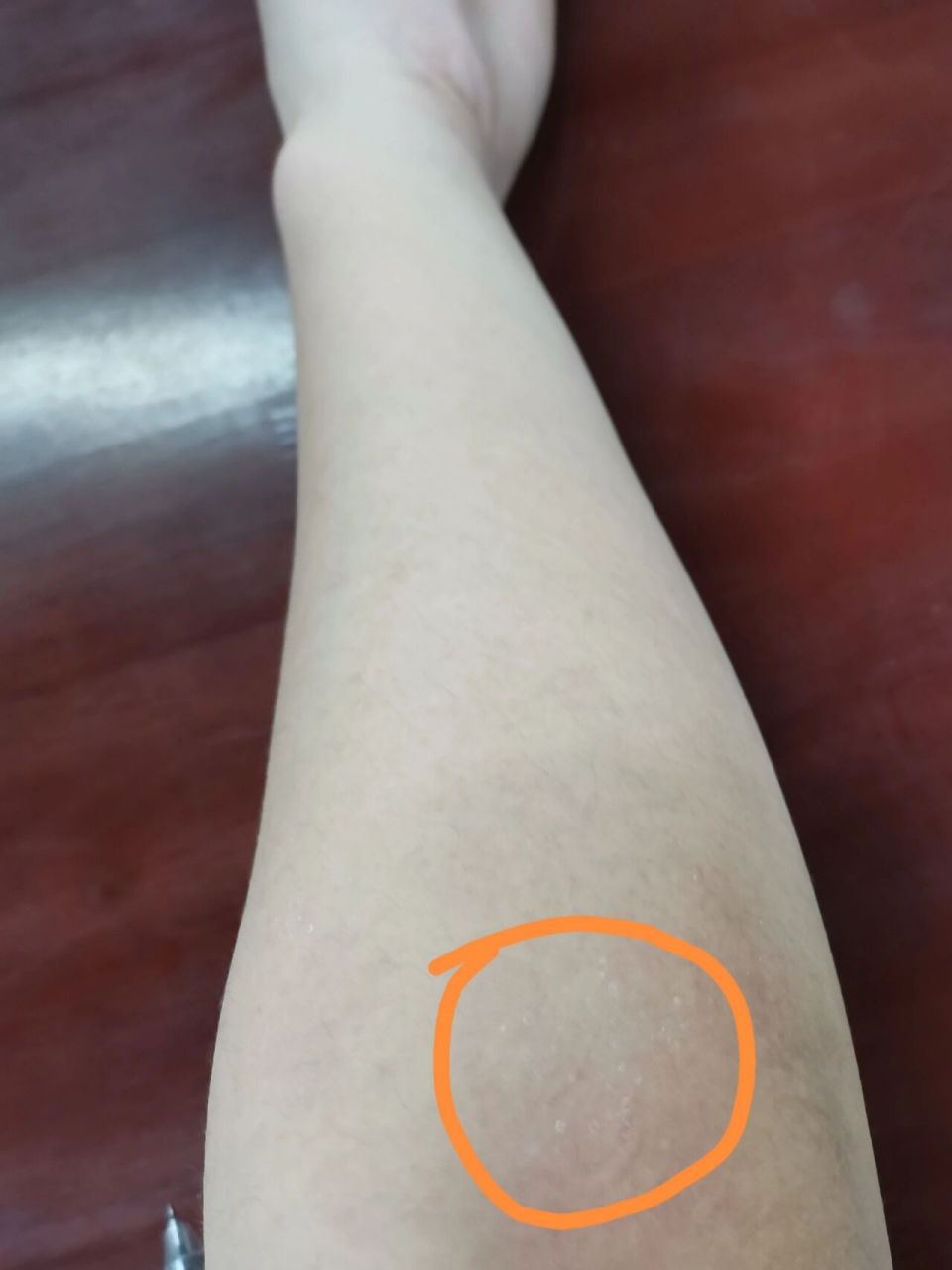 姐妹们,手臂上白白的小圆圈是藓吗 该怎么去掉啊?