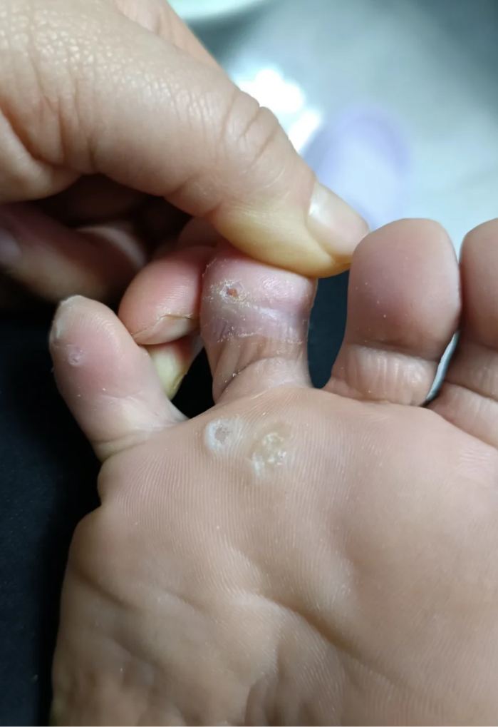 如果是刚长的跖疣,这时候脚底只会看到一块硬皮,还看不到黑点