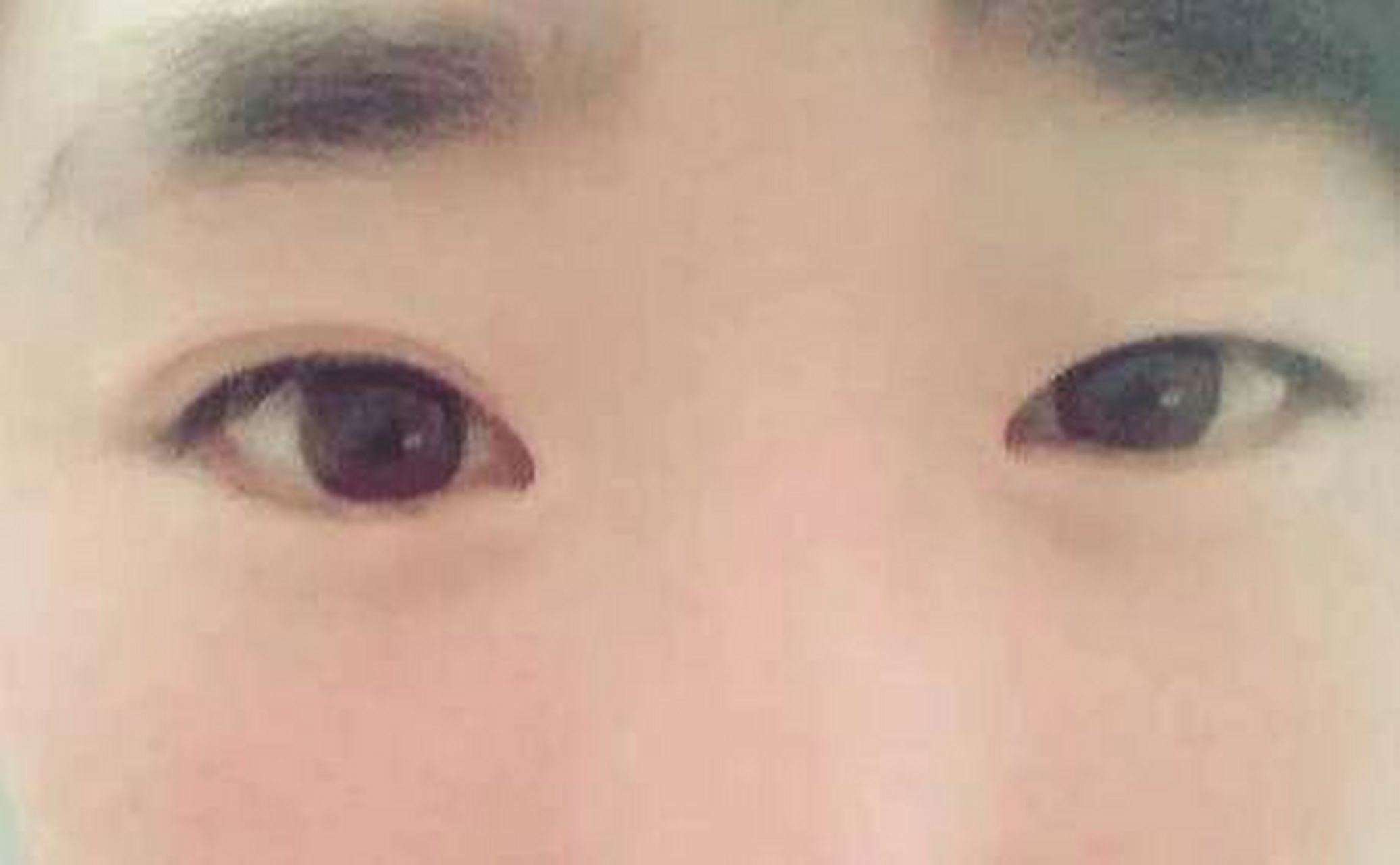 大小眼好不好 大小眼又称雌雄眼.