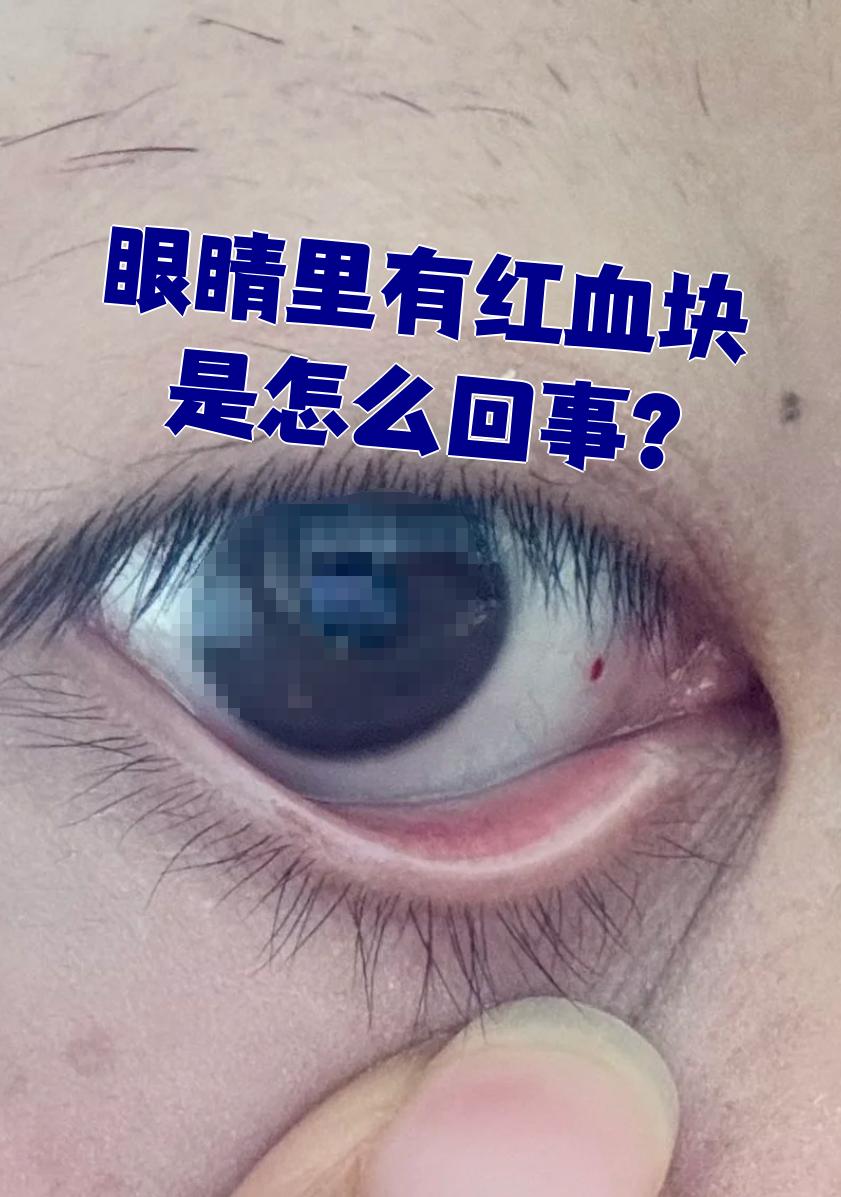 眼睛里有红血块是怎么回事?