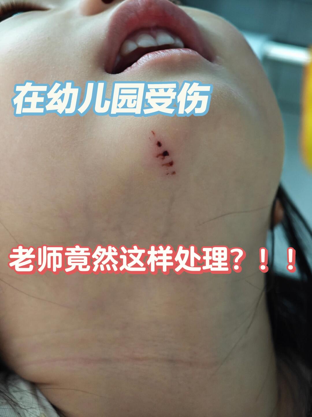 关于小朋友在幼儿园受伤