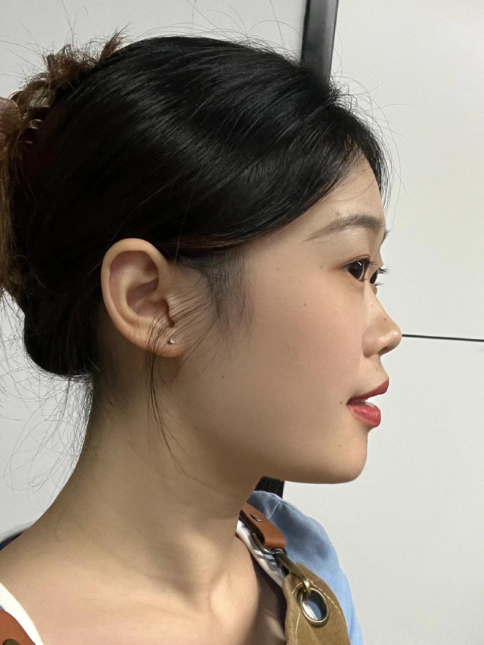 完全没有山根的侧脸 没有山根,圆鼻头,鼻基底凹陷,鼻梁也很低,下巴还