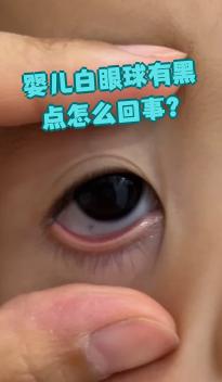 婴儿白眼球有黑点怎么回事?