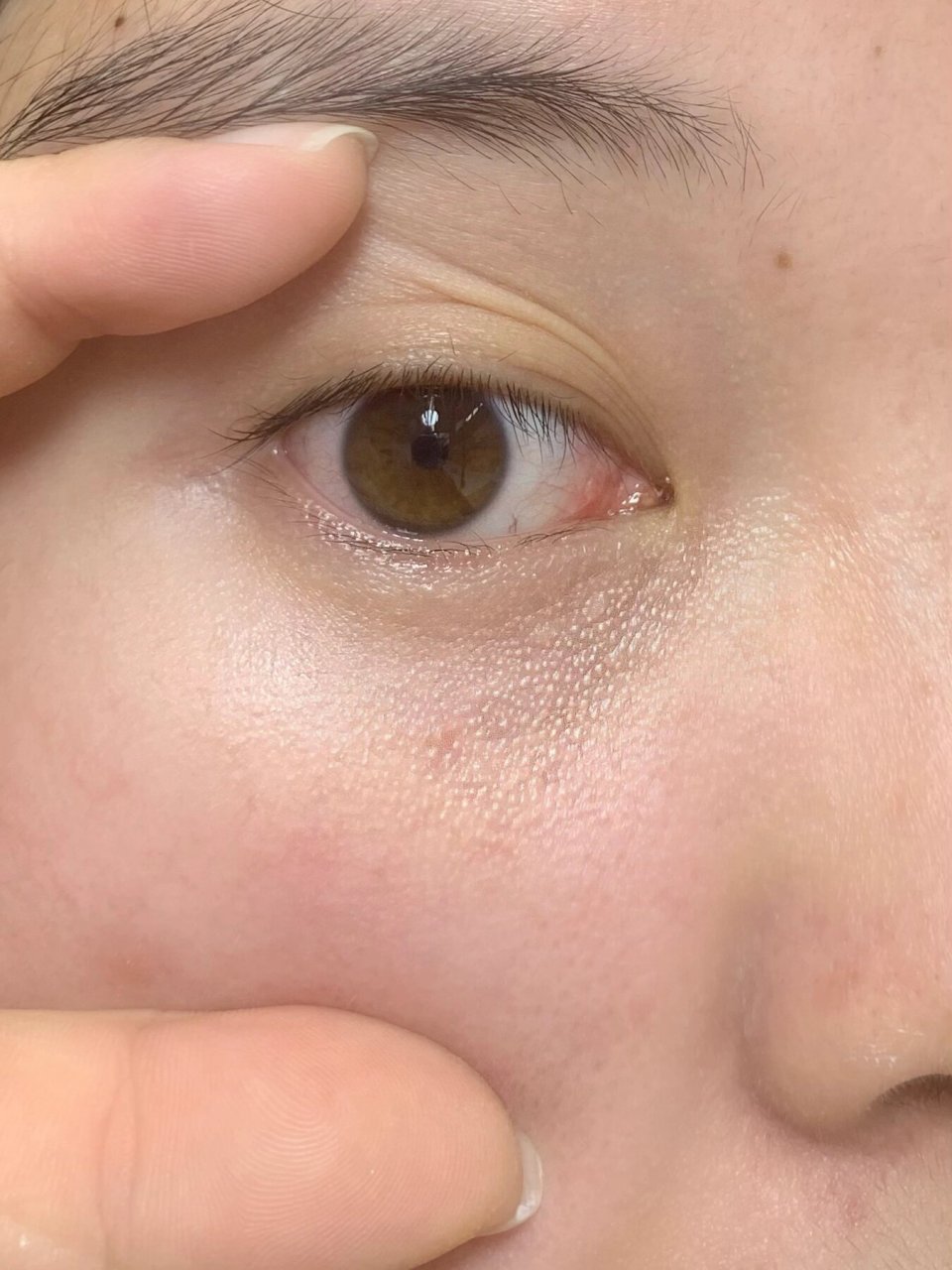 巨管用!(对眼周的疙瘩) 我眼周那里长了巨多小疙瘩!