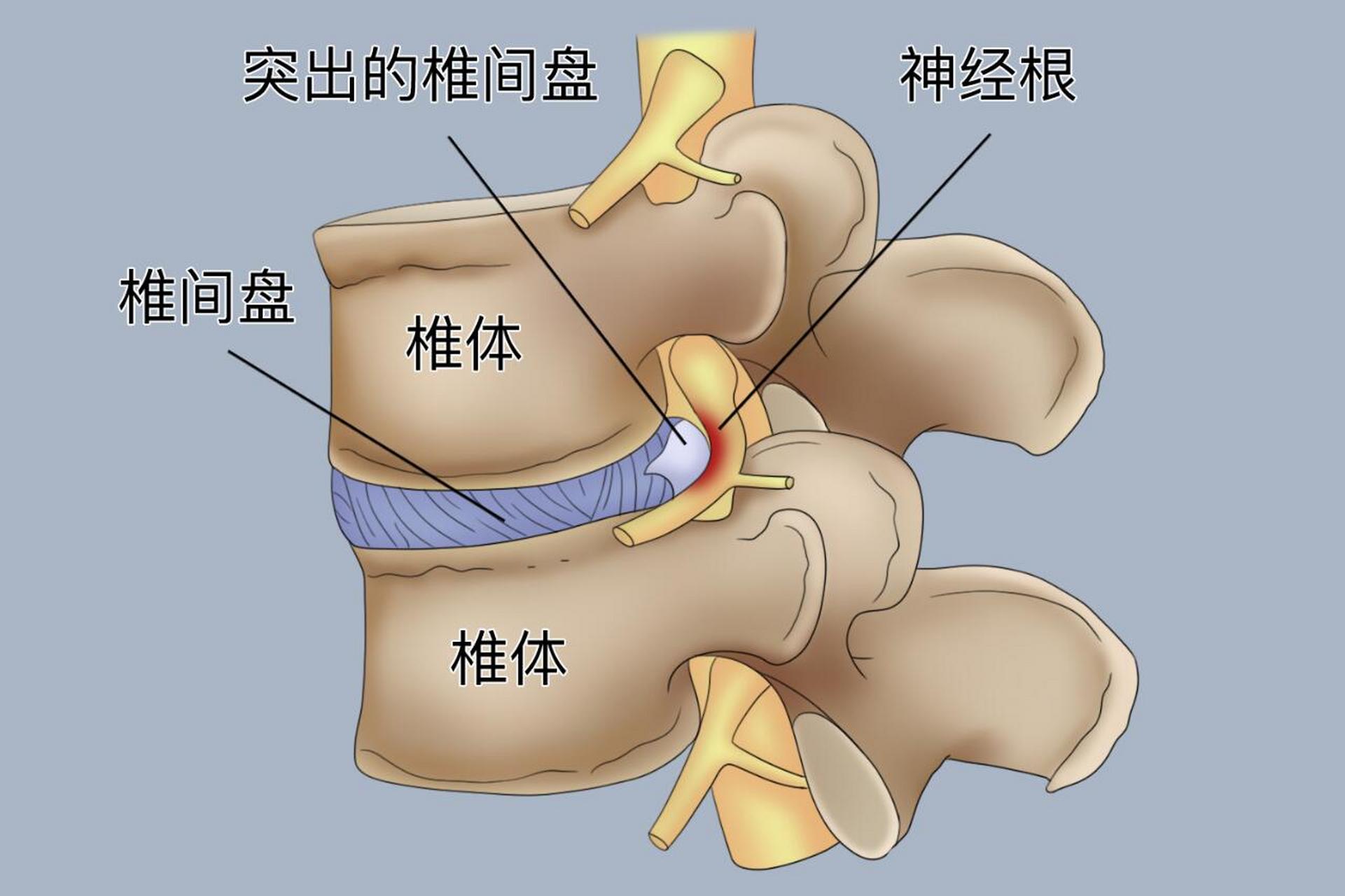 腰椎间盘突出影像图解图片