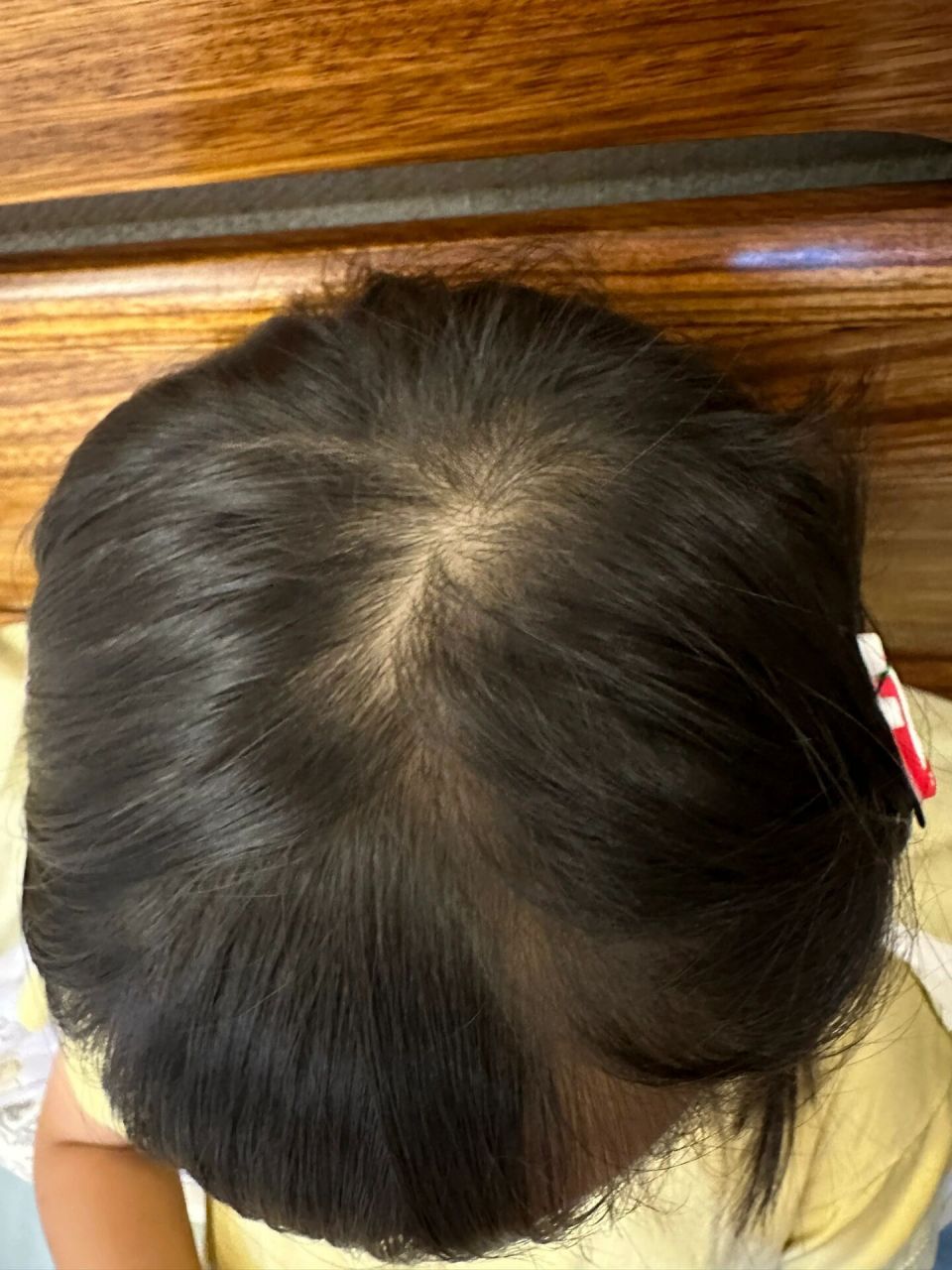 六岁半儿童休止期脱发～ 六岁半孩子忽然间脱发很厉害,早上起床梳头掉